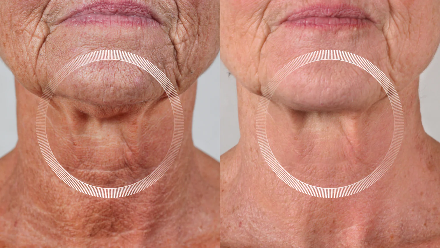 red light therapy for sagging jowls
